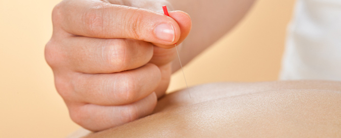 what to expect acupuncture