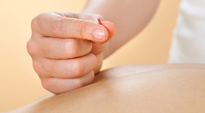 what to expect acupuncture
