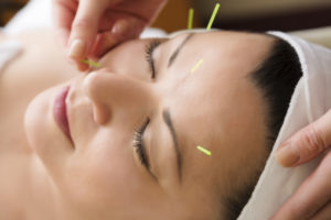 Acupuncture treatment at DASHA®